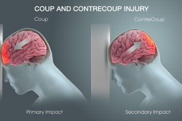 Diagram showing coup and contrecoup brain injuries: the left shows a head hitting a surface with primary impact to the front brain; the right shows secondary impact at the back of the brain, both highlighted in red.