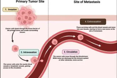 Diagram showing cancer metastasis: At the tumor site, cells invade tissue, then enter blood vessels (intravasation). They travel in the bloodstream (circulation) and exit vessels to form new tumors in tissues (extravasation).