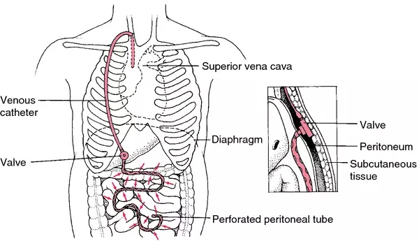 Medical diagram of a torso showing the path of a venous catheter from the chest to the superior vena cava, with labels for valve, diaphragm, peritoneum, perforated peritoneal tube, and subcutaneous tissue.